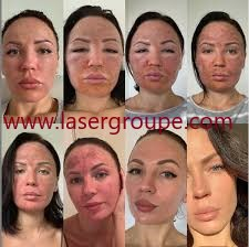 واردات لیزر Co2 پیکسل فرکشنال