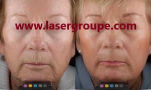 خرید اقساطی لیزر co2